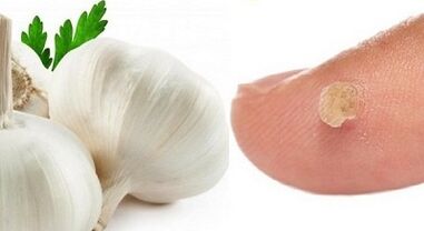 leczenie brodawek środkami ludowymi