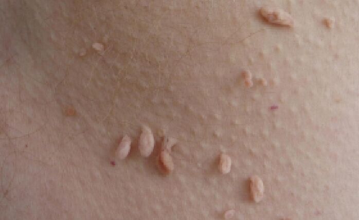 przyczyny pojawienia się brodawczaków na ciele ludzkim