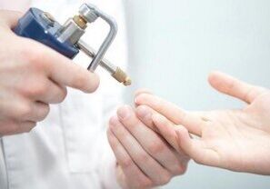 nowoczesne metody usuwania brodawczaków