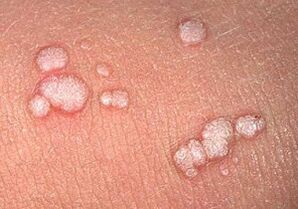 wulgarne brodawczaki na ludzkim ciele