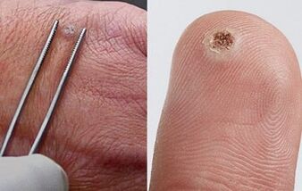 objawy brodawczaków na organizmie człowieka