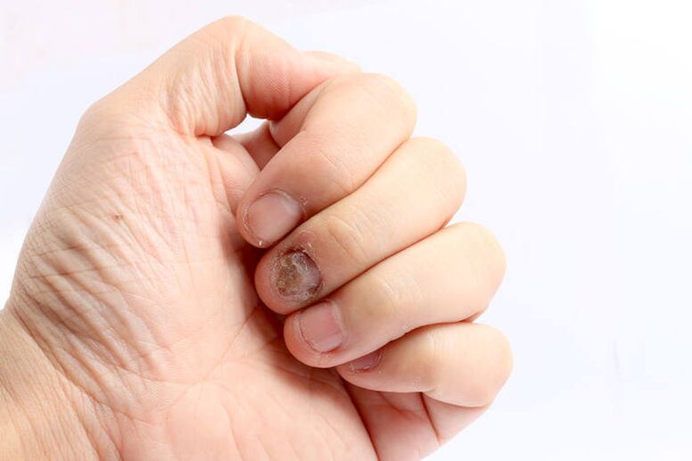 wskazanie do stosowania Keramin - grzybica paznokci